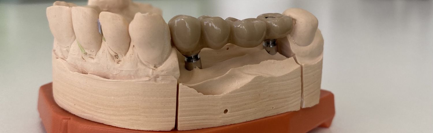 Trūkstošu zobu aizvietošana ar implantiem