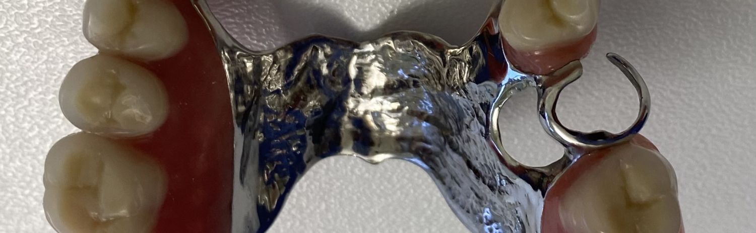 Implantu un zobu balstītas protēzes