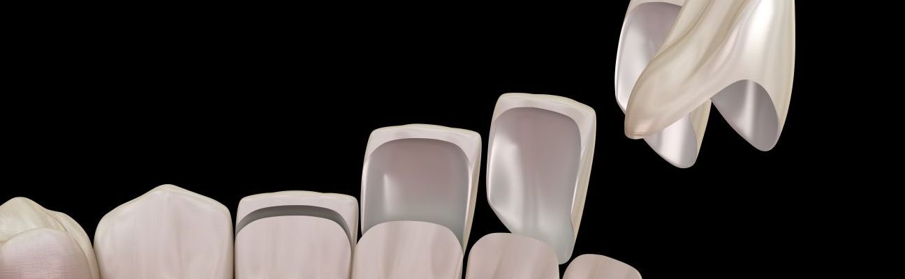 Venīrs vai kronītis, ko izvēlēties?