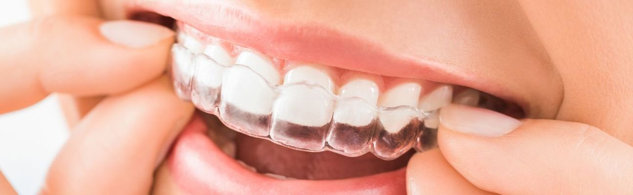 Zobu taisnošana ar ortodontiskajām kapēm