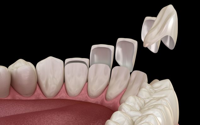 Venīrs vai kronītis, ko izvēlēties?